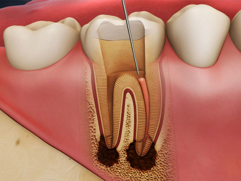 Root Canal Treatment: Busting the Myths and Restoring Your Smile at Dental Concepts Clinic
