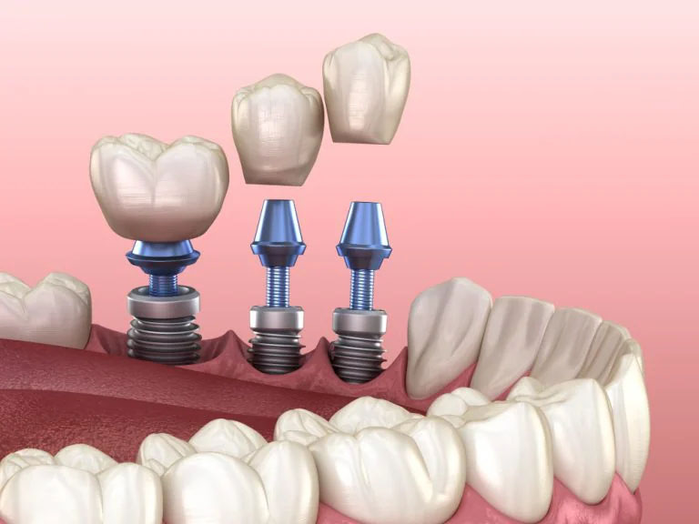 Dental Implants: Restoring Your Smile and Confidence with Dental Concepts Clinic